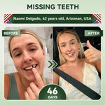 SmileRenew Dental Repair Strips