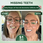 SmileRenew Dental Repair Strips