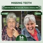 SmileRenew Dental Repair Strips