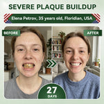 SmileRenew Dental Repair Strips