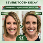 SmileRenew Dental Repair Strips