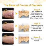 PsoriaSoothe Bee Venom Rescue Cream