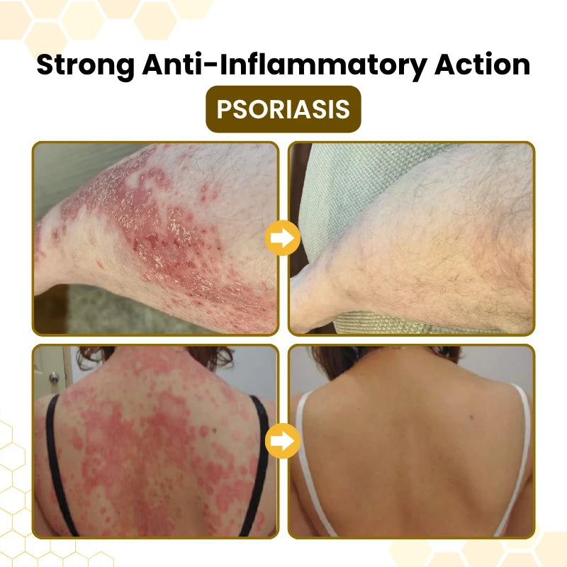 PsoriaSoothe Bee Venom Rescue Cream