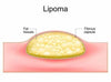 Cyuz Herbal Lipoma Cream