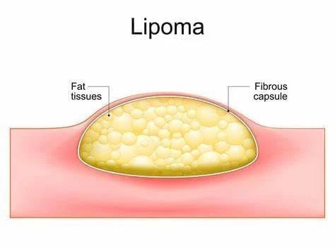 Cyuz Herbal Lipoma Cream