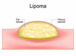 Cyuz Herbal Lipoma Cream