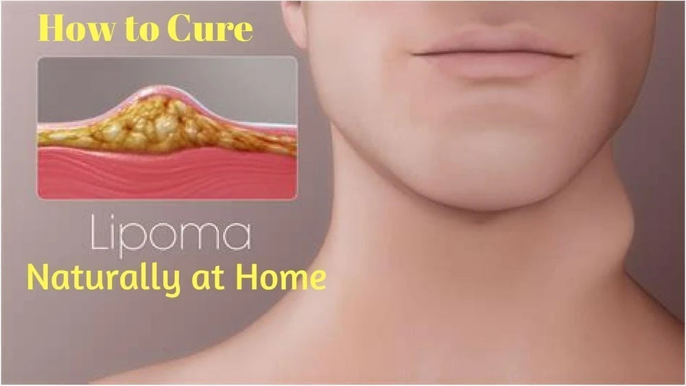 Cyuz Herbal Lipoma Cream