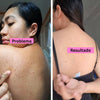 Back Acne  Spray