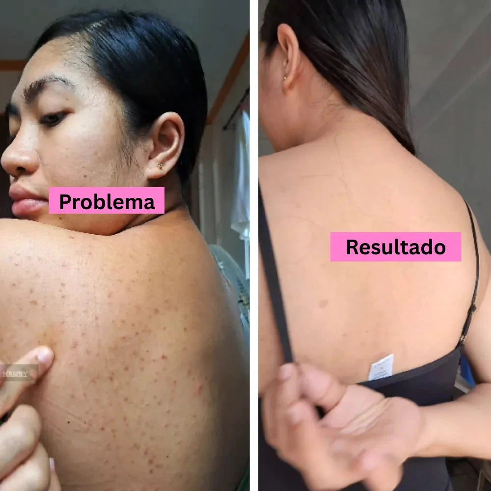 Back Acne  Spray
