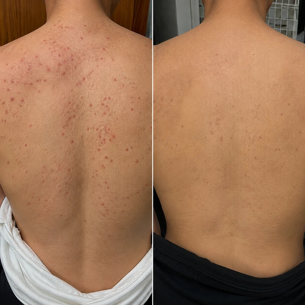 Back Acne  Spray