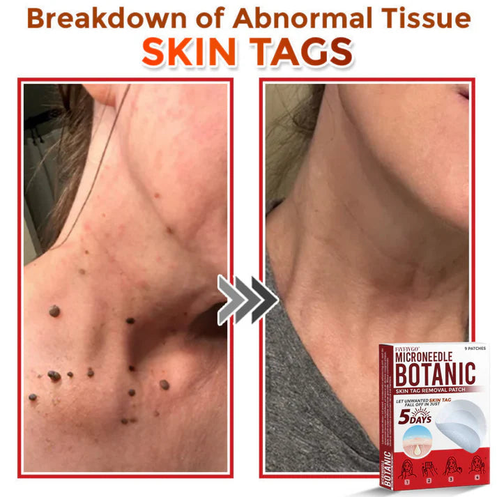 Botanic Skin Tag Removal Patch